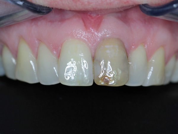 ZIRCONCERAMIC CROWN AND ROOT CANAL OF THE UPPER LARGE INCISOR